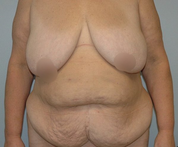 Vertical abdominoplasty Before