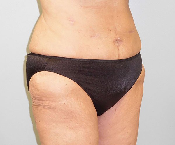 Vertical abdominoplasty After