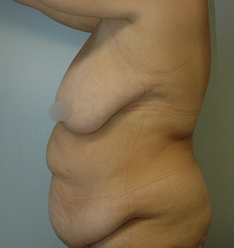 Vertical abdominoplasty Before