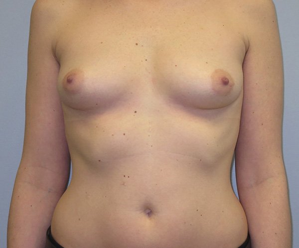 Breast Augmentation-Before