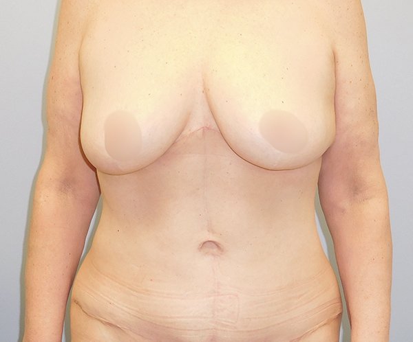 Vertical abdominoplasty After