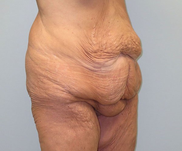 Vertical abdominoplasty Before