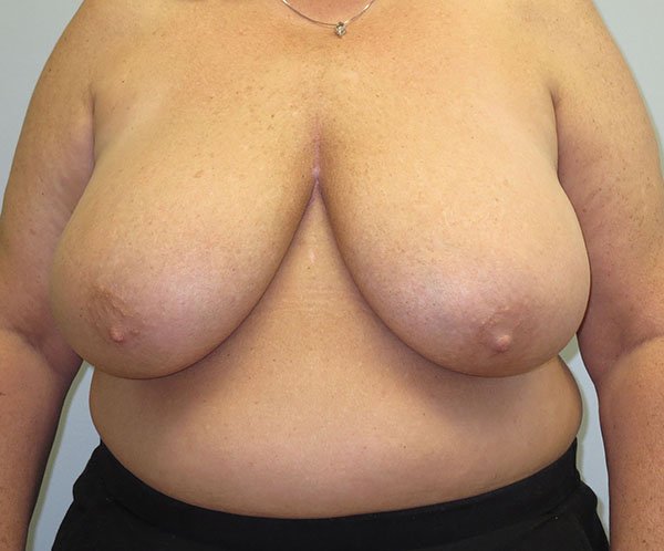 Breast Augmentation-Before