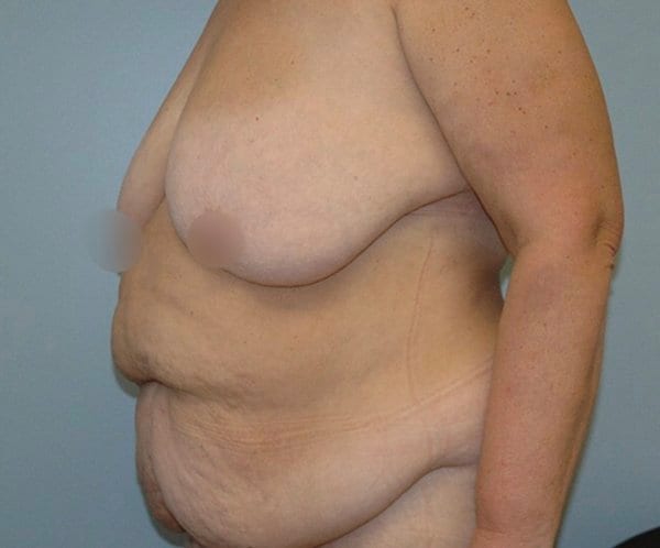 Vertical abdominoplasty Before