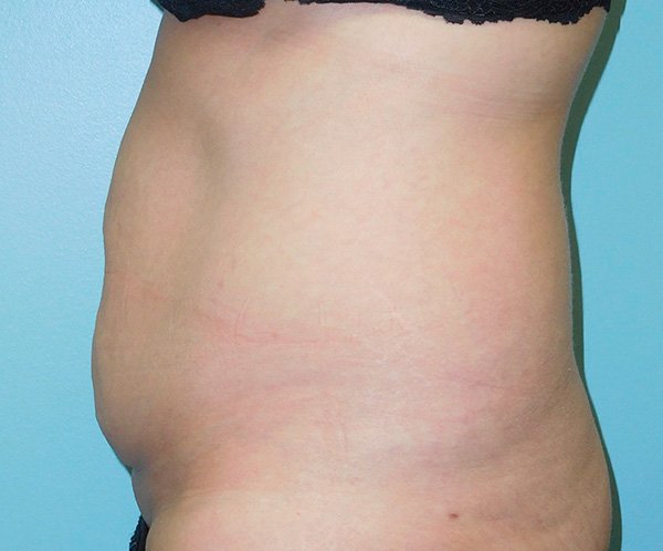 Tummy Tuck Before