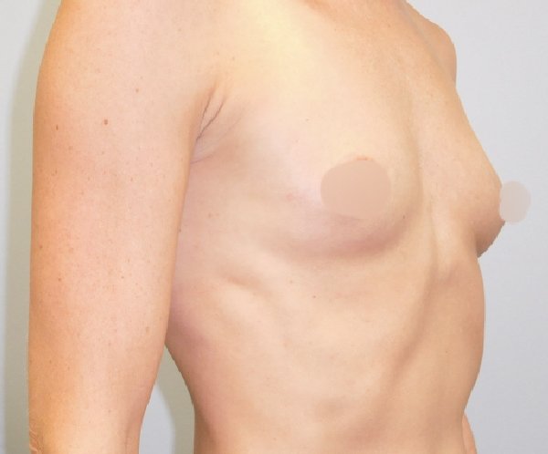 Breast Augmentation-Before